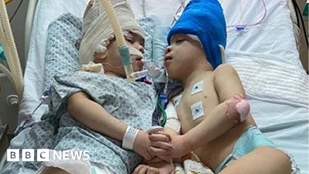 Conjoined Brazilian twins separated with help of VR-صحيفة الصوت
