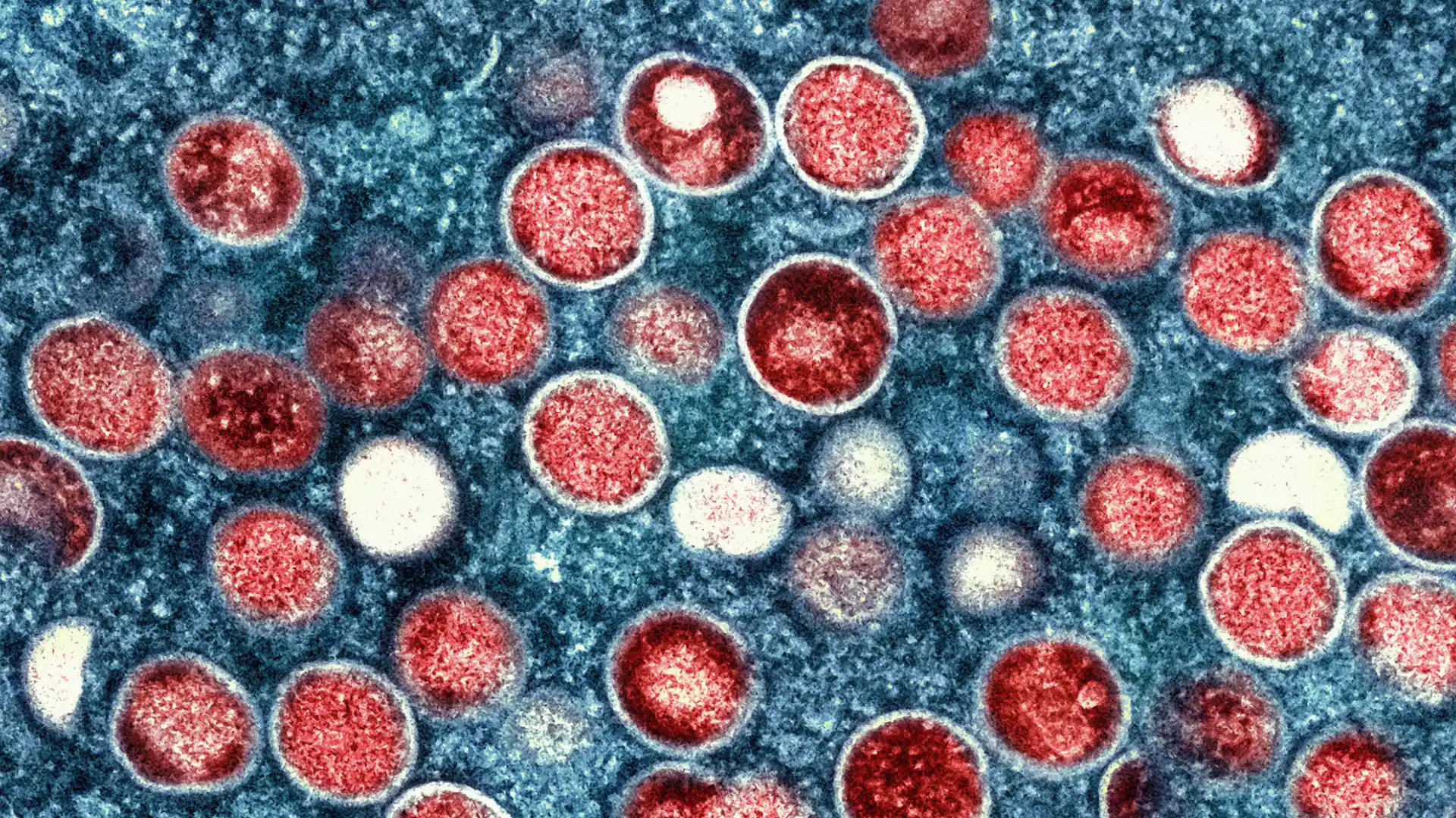 Your monkeypox questions, answered | CBC.ca-صحيفة الصوت