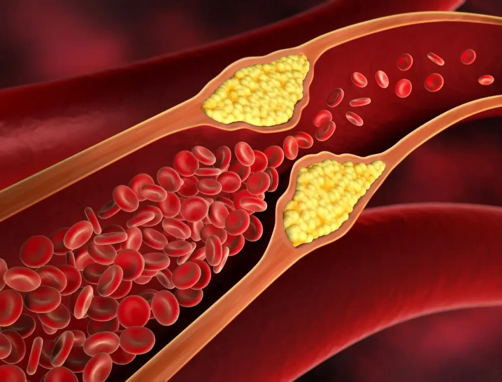 ما هو الكوليسترول LDL و لماذا يجب عليك متابعته ؟ – صحيفة الصوت